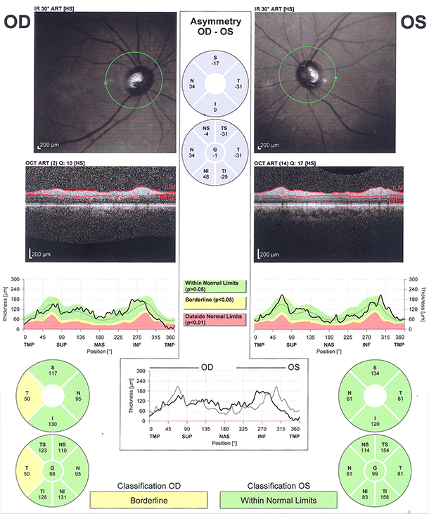 OCT glaucoma