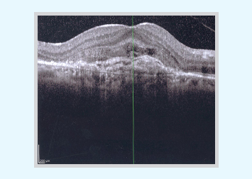 Age Related Macular Degeneration