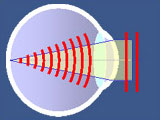 wavefront lasik