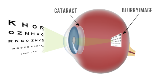Ovisus | Chirurgie ochi - Oftalmologie - Tratamentul cataractei Chisinau