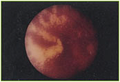 Advanced Diabetic Retinopathy