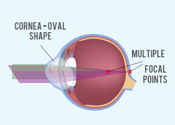 Astigmatism