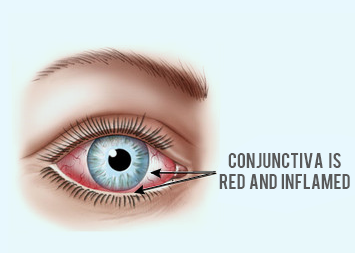 Conjuctivitis