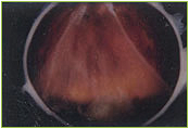 Diabetic Retinopathy with Retinal Detachment