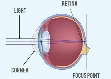 Hyperopia