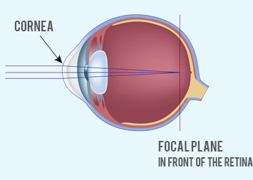 Myopia