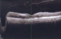 Retina after Injected Lucentis