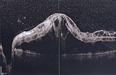 Retina due Diabetic