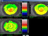 Topography lasik