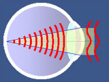 wavefront lasik